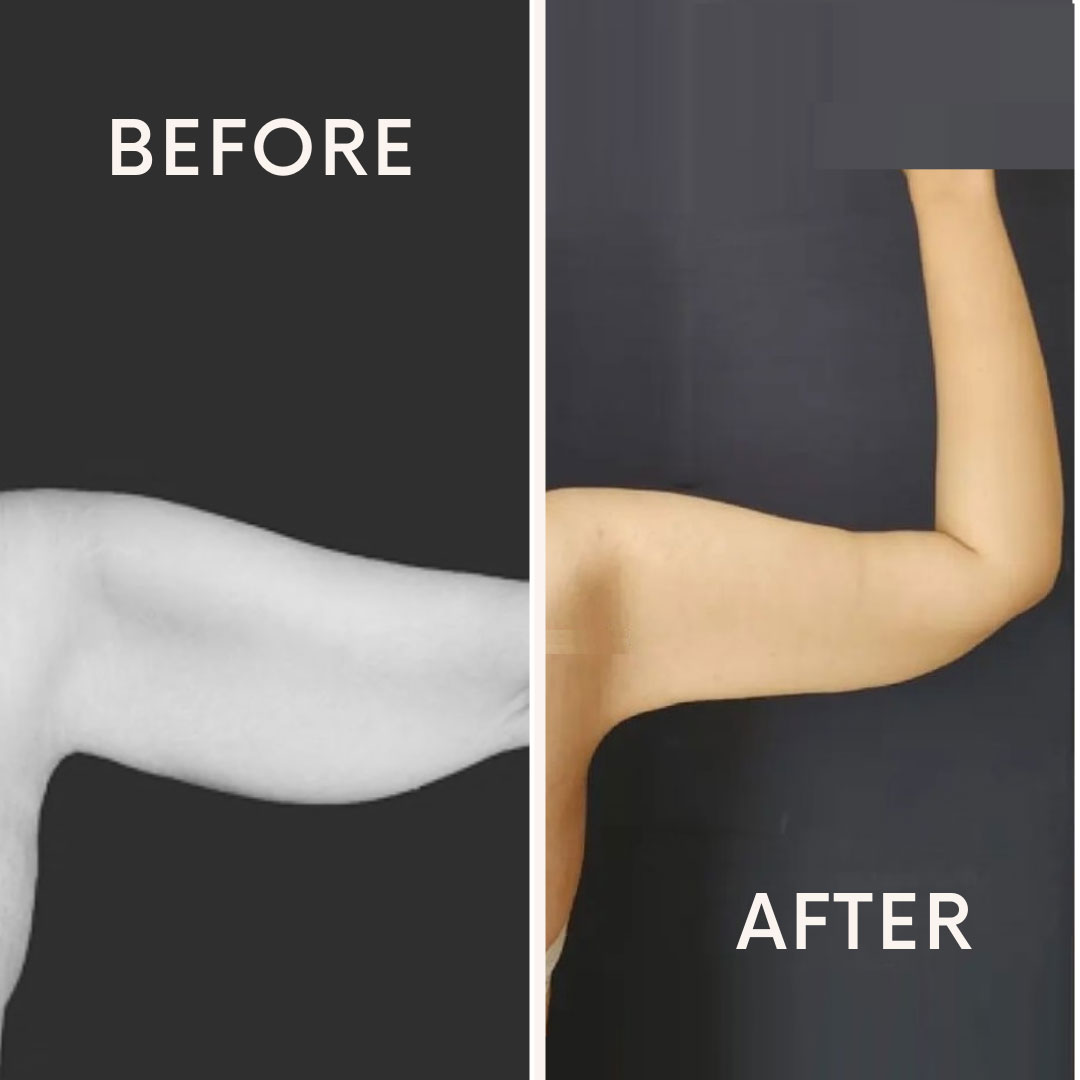 Arm Lift Surgery Nora Health Tour