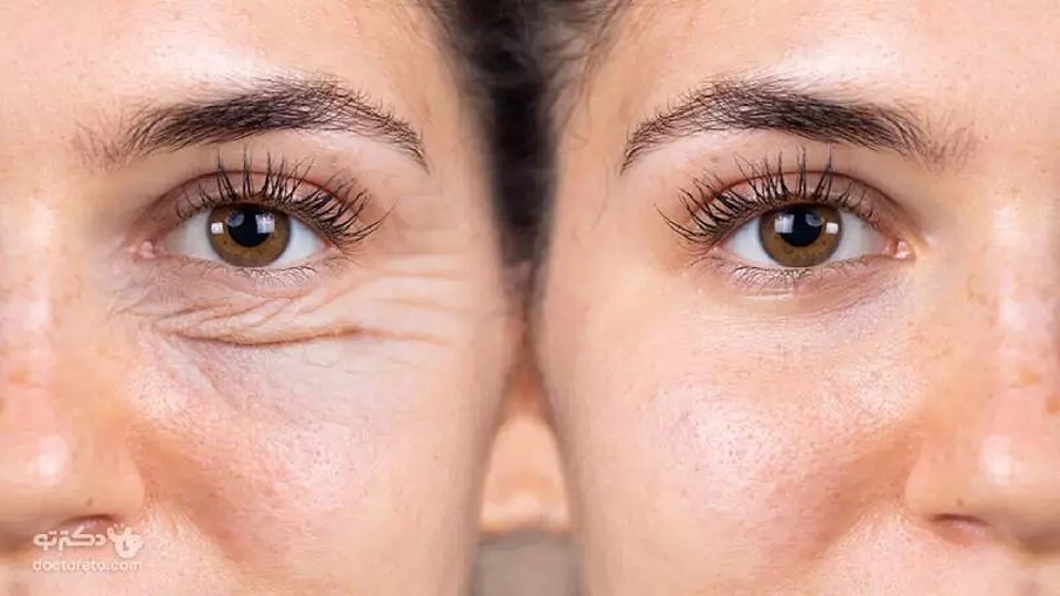 Blepharoplasty and brow lift