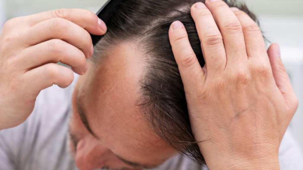 Hair Transplantation