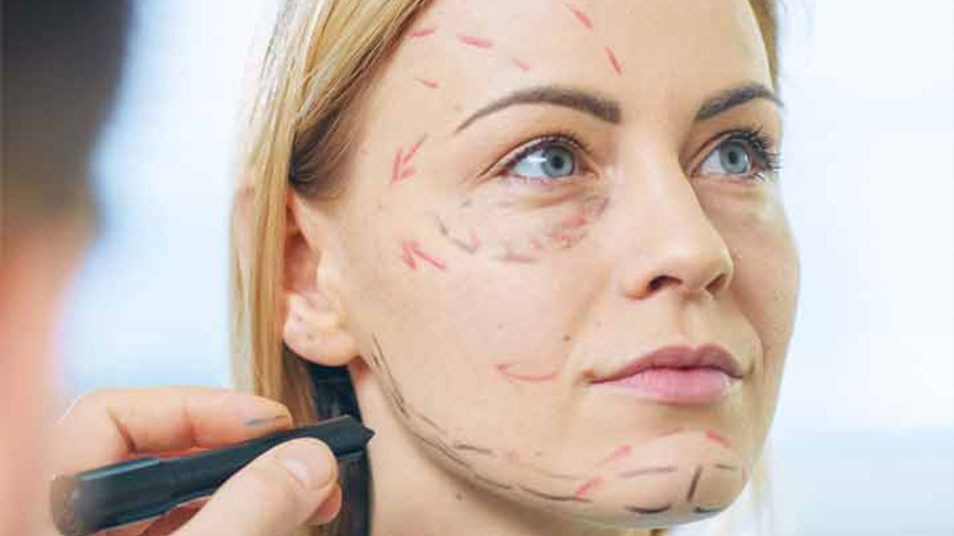 Facelift Surgery